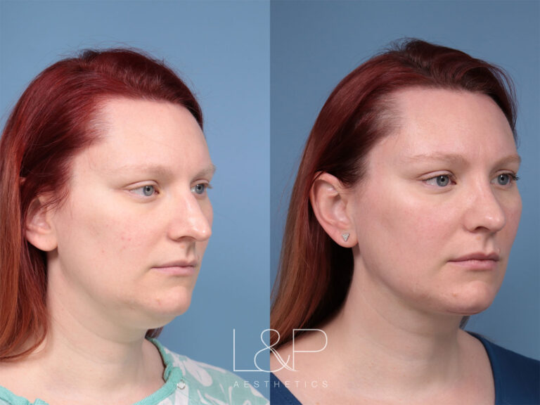 Female Midline Neck Lift with Rhinoplasty-FT