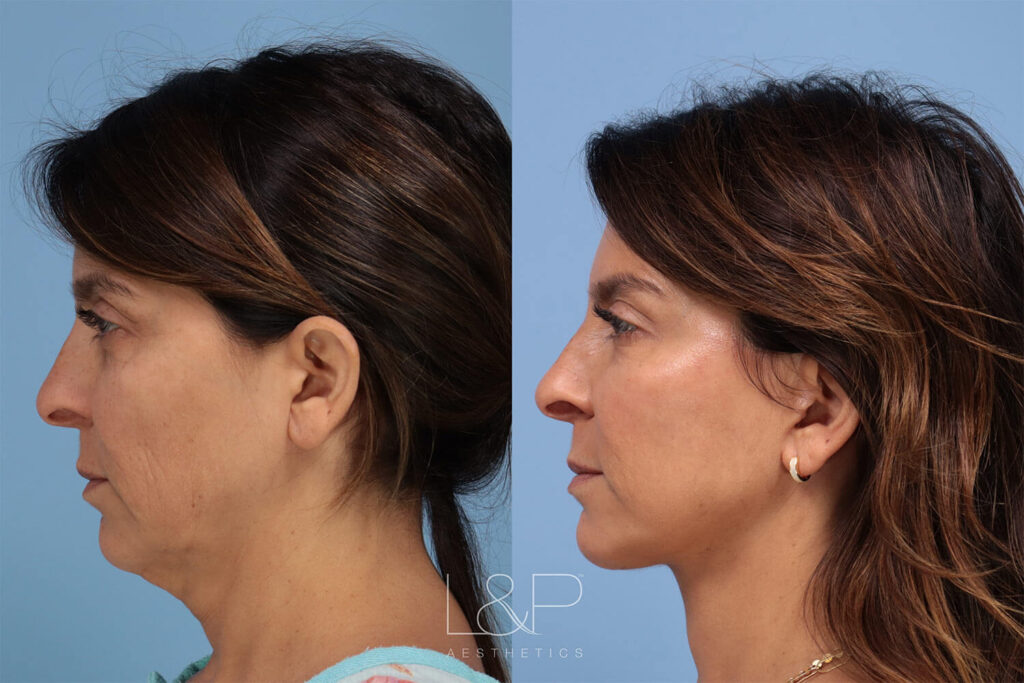 Before and after deep plane facelift in Palo Alto, CA