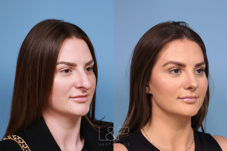 Before and After of a Female Rhinoplasty Patient in Palo Alto, CA