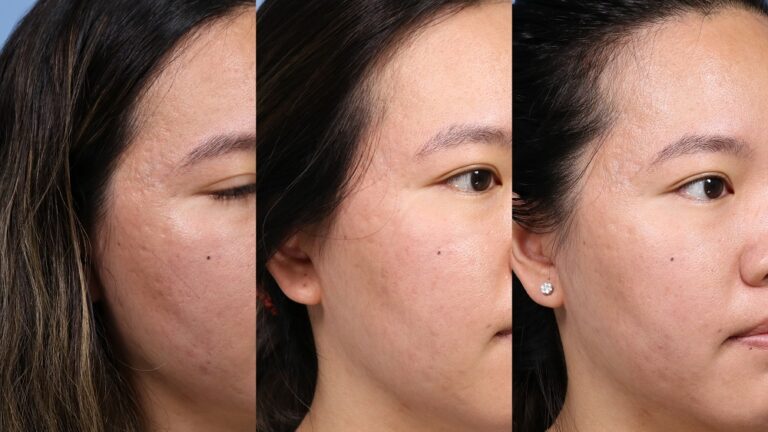 a woman pictured 3 times, before, after 1 and after 2 microneedling treatments.