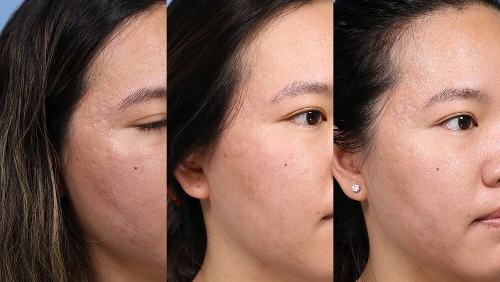 a woman pictured 3 times, before, after 1 and after 2 microneedling treatments.