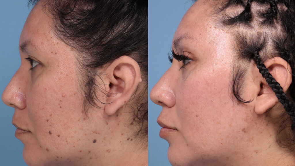 Before/after image of a woman who underwent the UltraClear laser