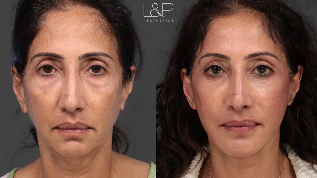 Before and after facelift in Palo Alto, CA