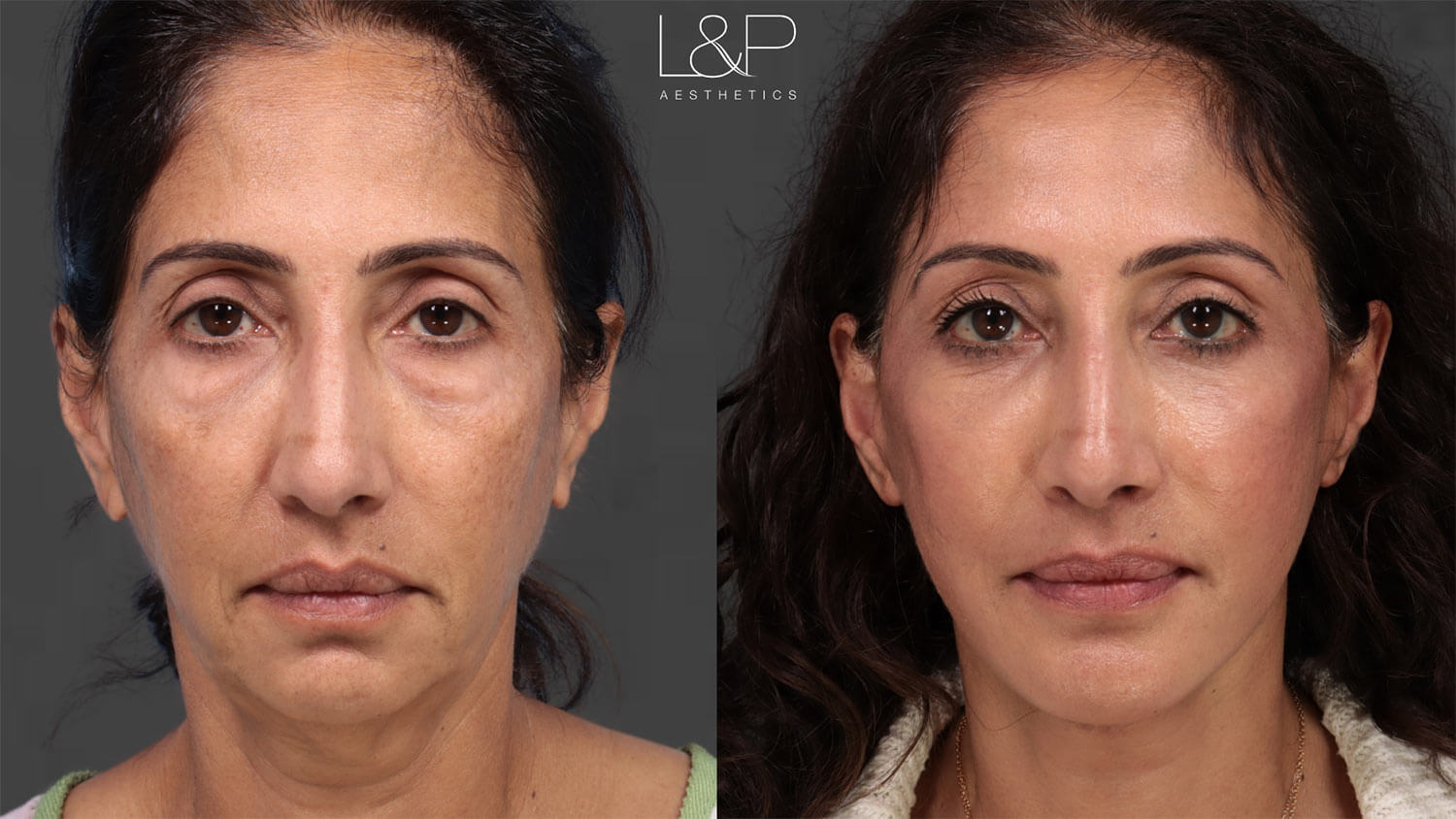 Before and after facelift in Palo Alto, CA