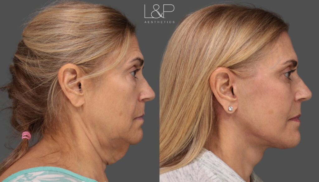 Side by side images of a woman before and after under going a deep plane face and neck lift at L&P Aesthetics