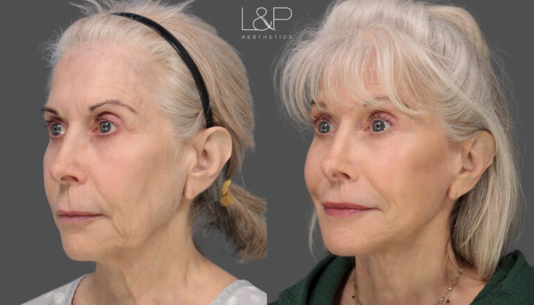 Female Facelift at 69 - FT