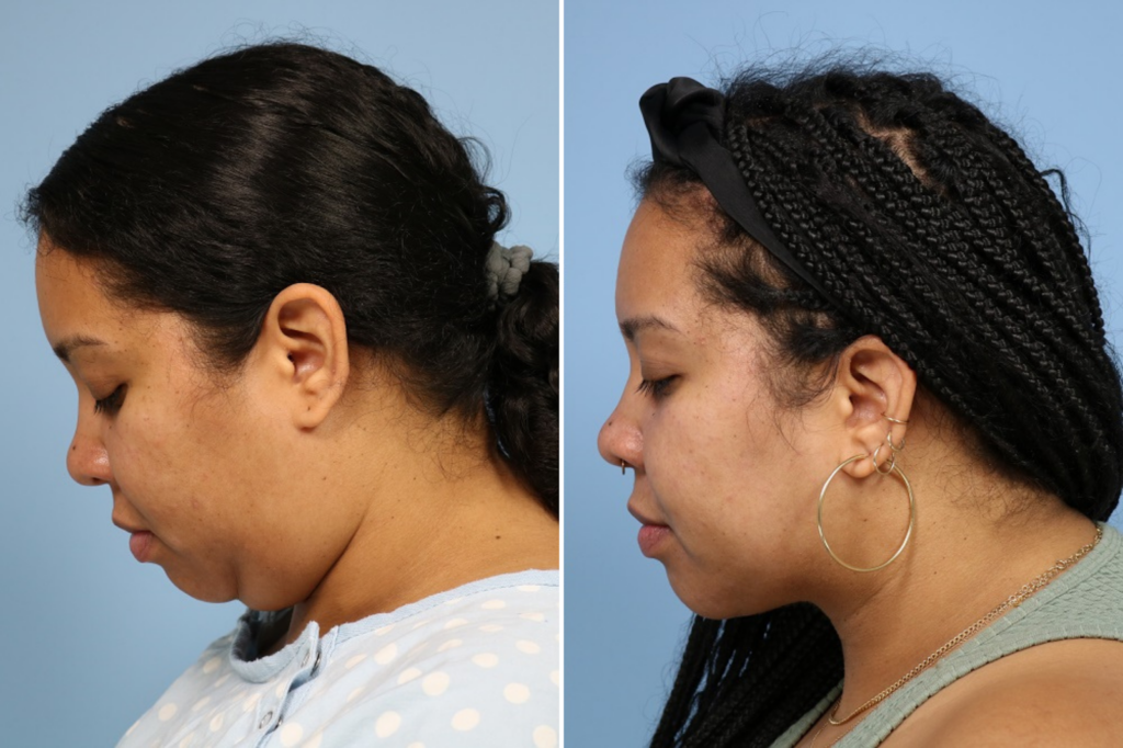 Before and after deep neck contouring in Palo Alto, CA