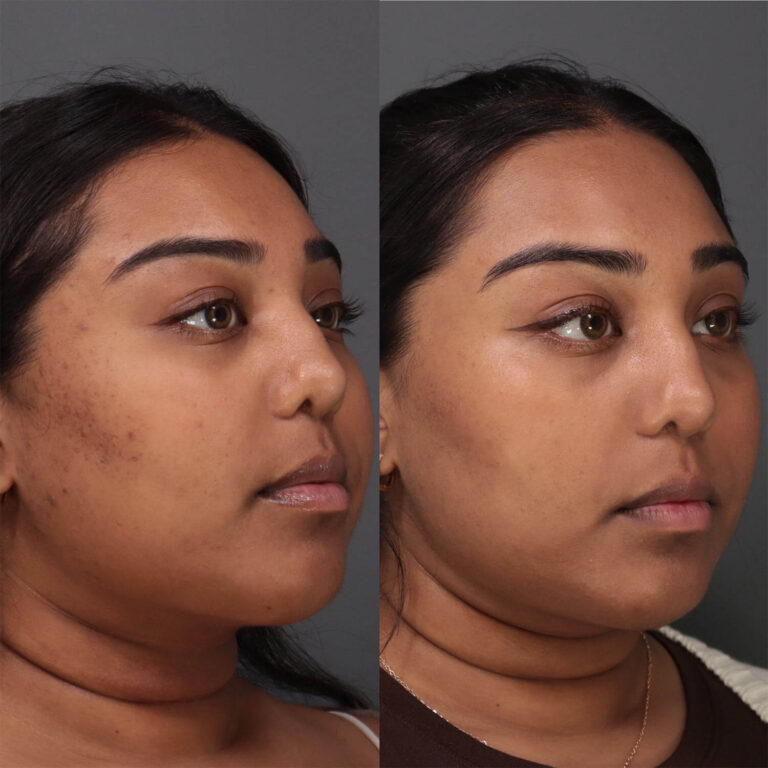 Hyperpigmentation addressed with UltraClear, Case 40- FT