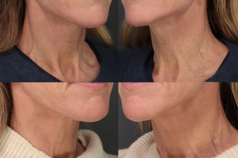 Tight and firm neck after UltraClear Level 2, Case 15 - FT