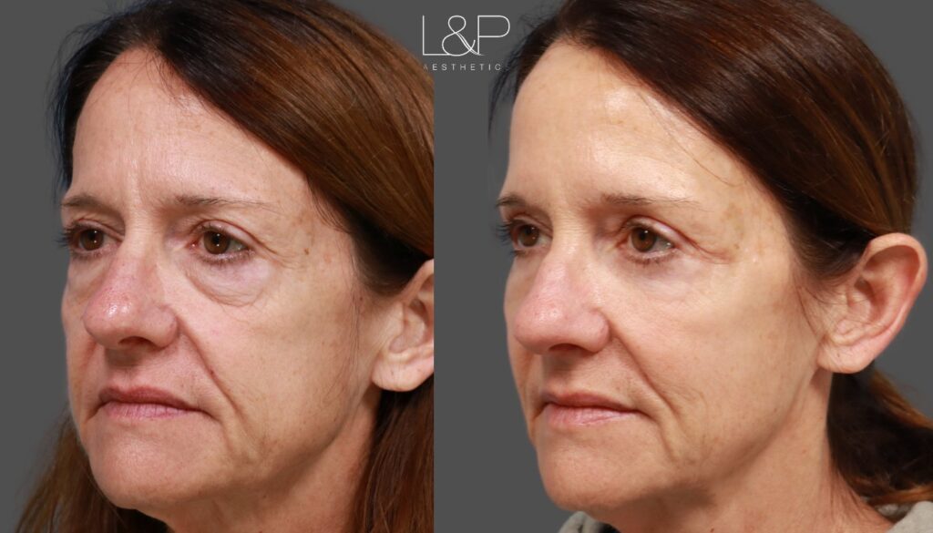 Lower blepharoplasty patient before and after at L&P Aesthetics in Palo Alto