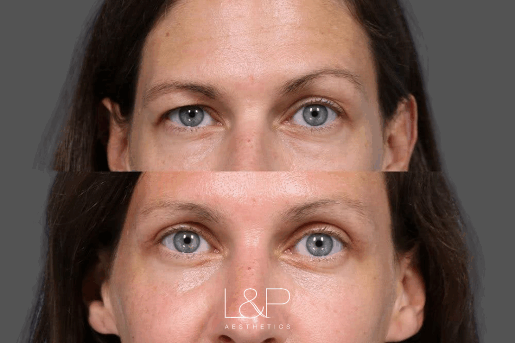 Before and after up an upper blepharoplasty in Palo Alto