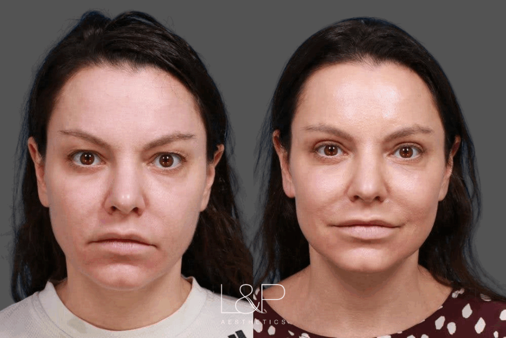 Before and after an upper blepharoplasty at L&P Aesthetics