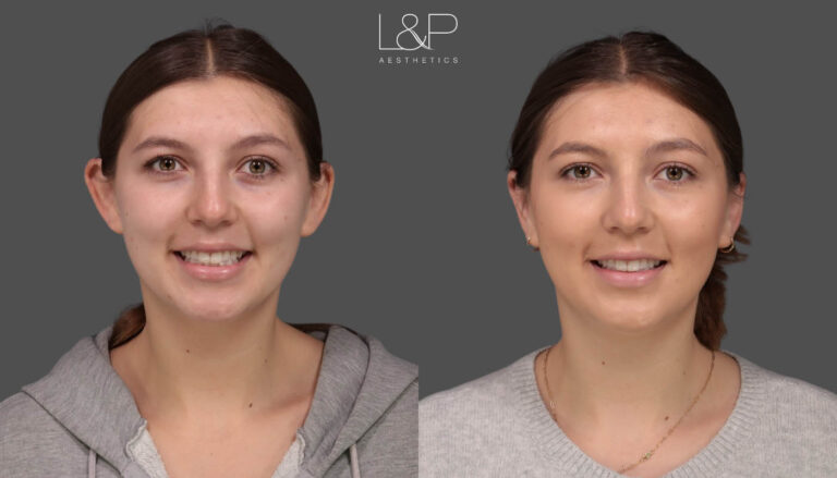 CC Otoplasty Palo Altopng