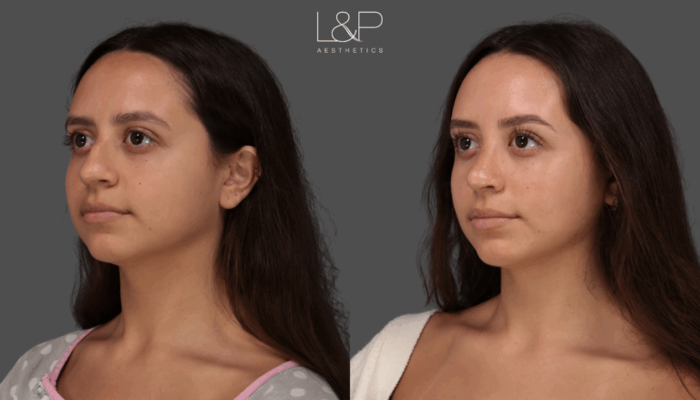 Rhinoplasty 1