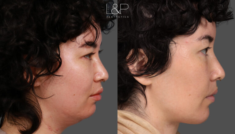 Necklift Chin right