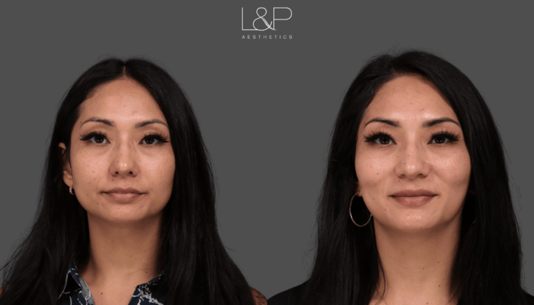 AR FillerBotox