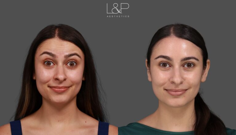 EL Botox