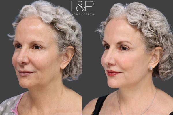 This gorgeous woman received the L&P Signature Facelift and Neck Lift, which is a great example of why we favor the Deep Plane approach. It lifts at the structural level, restoring youthful contours while maintaining a completely natural appearance that lasts.