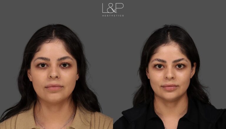 Profile changes with fillers at L&P Aesthetics