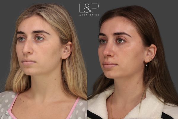 left 3/4 view of a young woman who got a rhinoplasty at L&P Aesthetics