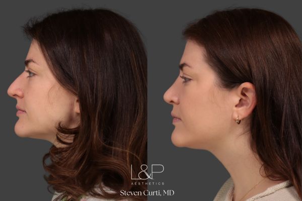 left sid view of a woman with a rhinoplasty by Steven Curti, MD