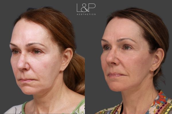 right 3/4 view of a smiling woman who got a full facelift and necklift at L&P Aesthetics