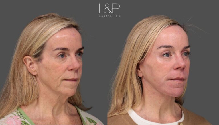 Facelift, Neck Lift, Endoscopic Brow Lift Case 55 -FT