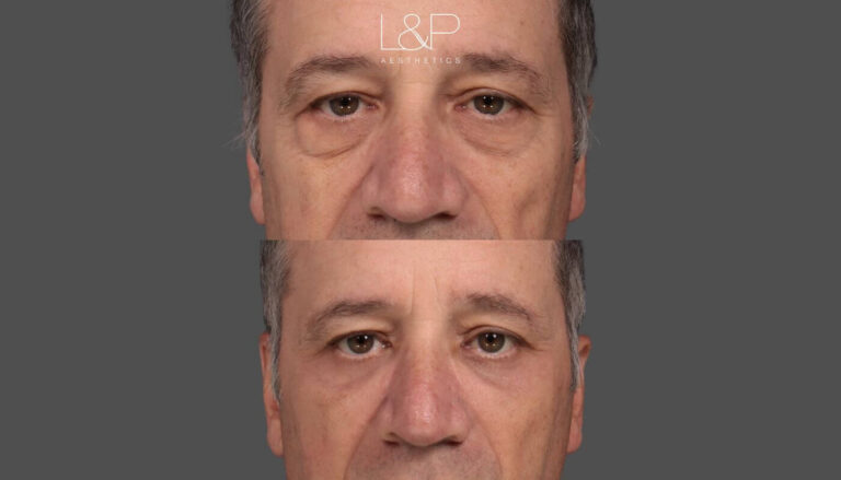 Lower Eyelid Rejuvenation with Fat Grafting for a Male, Case 5 -FT